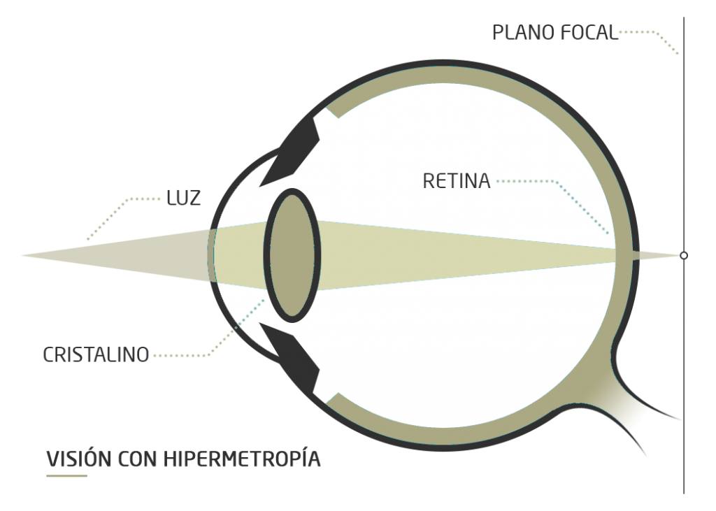 Hipermetropía Qué Es Y Tratamiento Clínica Rahhal Valencia