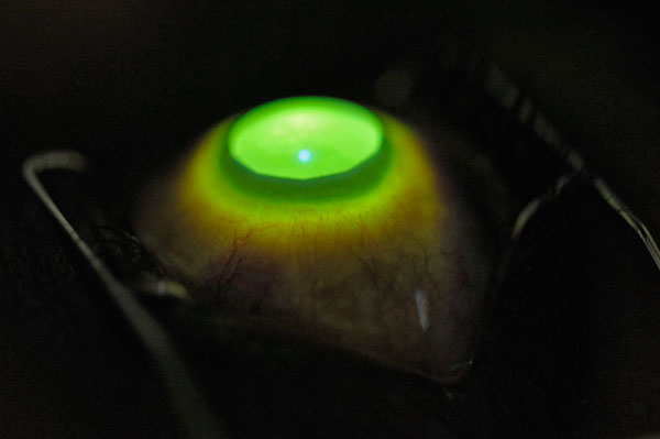 Cross-linking corneal