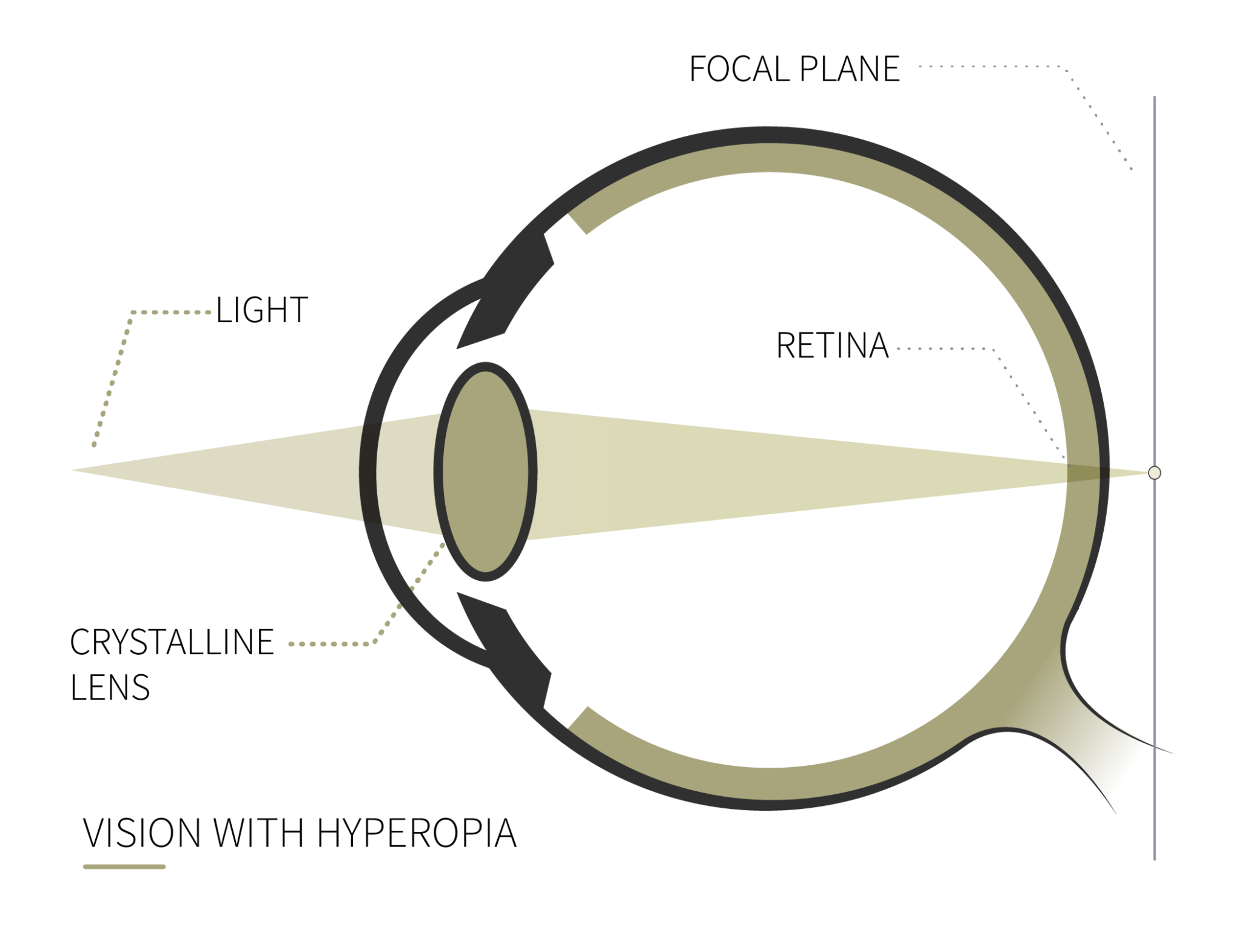 Hyperopia | What is it and treatment - Clínica Rahhal